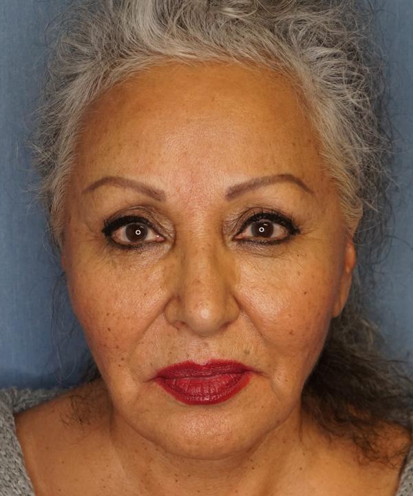 Herte Center for Cosmetic Surgery blepharoplasty after — Las Vegas, NV