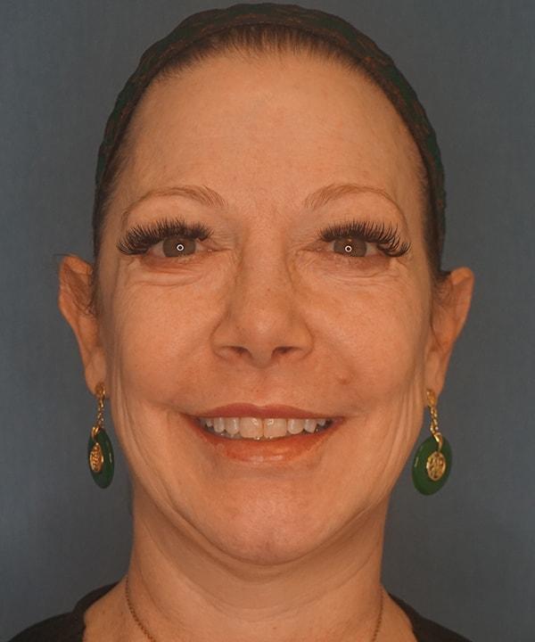 Facelift before at Herte Center for Cosmetic Surgery in Las Vegas, NV