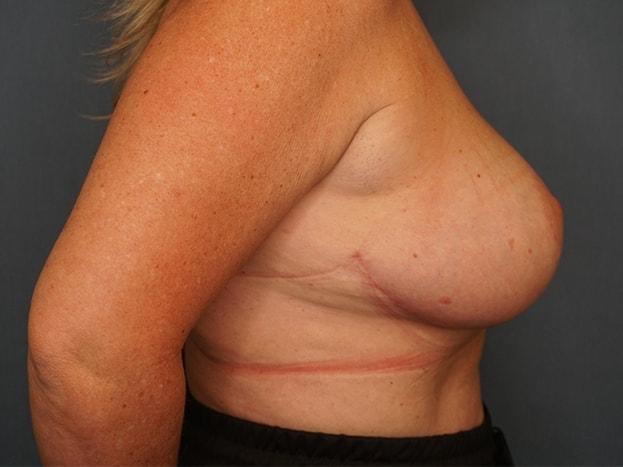Breast Reduction after at Herte Center for Cosmetic Surgery in Las Vegas, NV