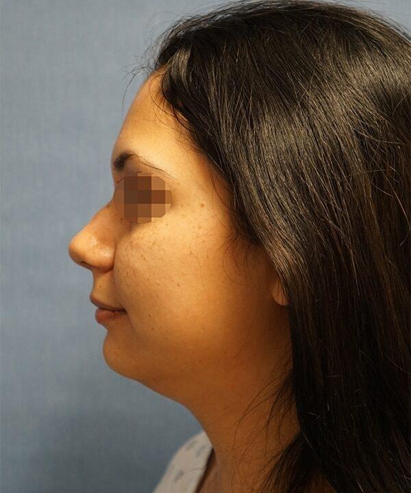 Chin Implant before at Herte Center for Cosmetic Surgery in Las Vegas, NV