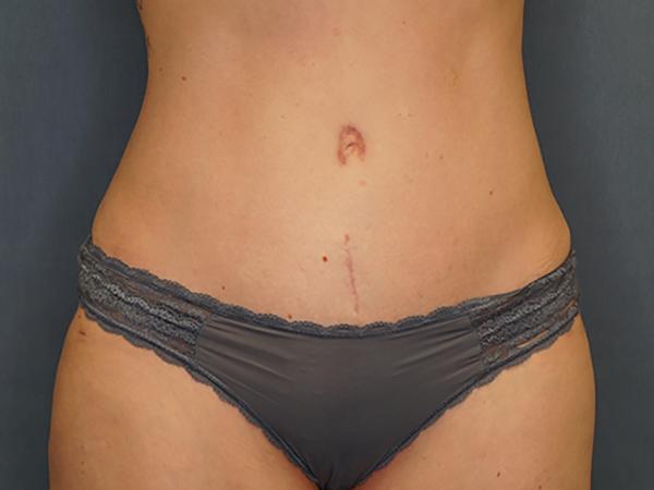 Tummy Tuck after at Herte Center for Cosmetic Surgery in Las Vegas, NV