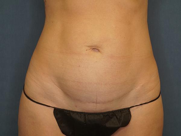Tummy Tuck before at Herte Center for Cosmetic Surgery in Las Vegas, NV