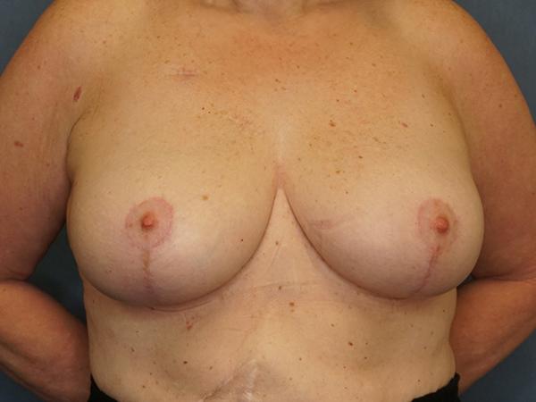 Breast Lift after at Herte Center for Cosmetic Surgery in Las Vegas, NV