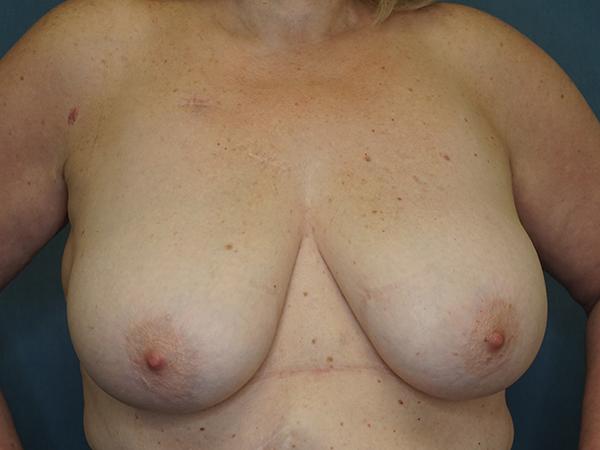 Breast Lift before at Herte Center for Cosmetic Surgery in Las Vegas, NV