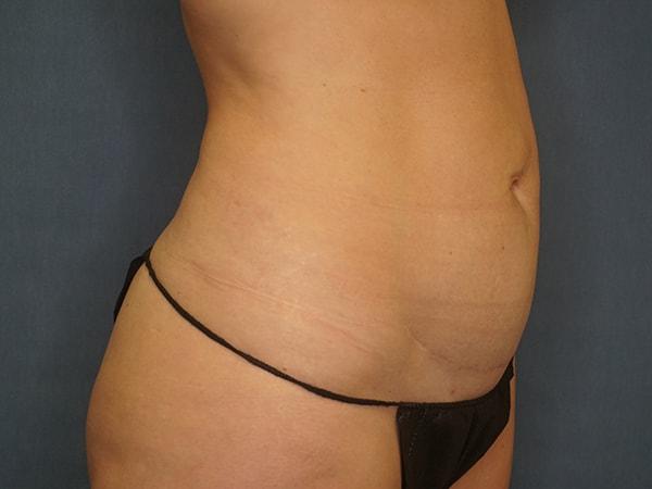 Mini Tummy Tuck before at Herte Center for Cosmetic Surgery in Las Vegas, NV