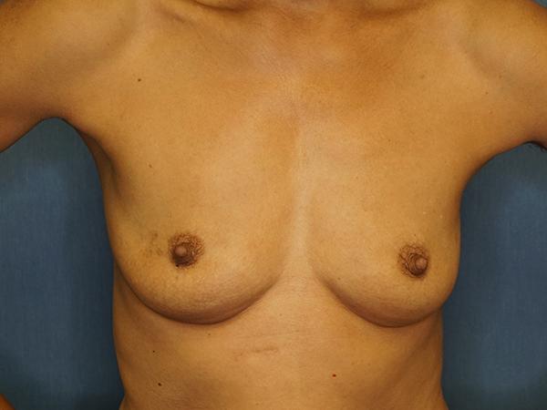 Breast Augmentation before at Herte Center for Cosmetic Surgery in Las Vegas, NV