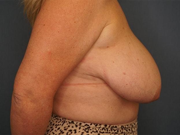 Breast Reduction before at Herte Center for Cosmetic Surgery in Las Vegas, NV