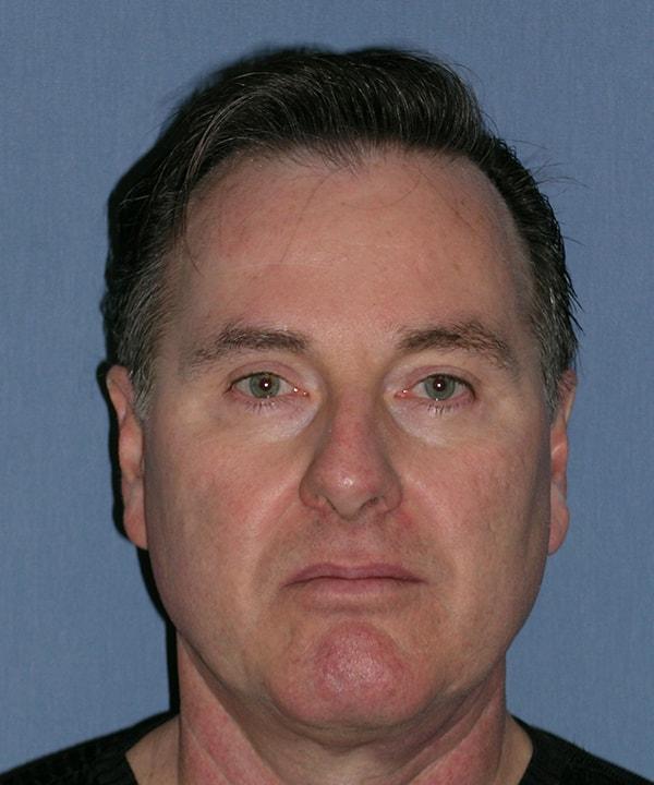 Blepharoplasty after at Herte Center for Cosmetic Surgery in Las Vegas, NV