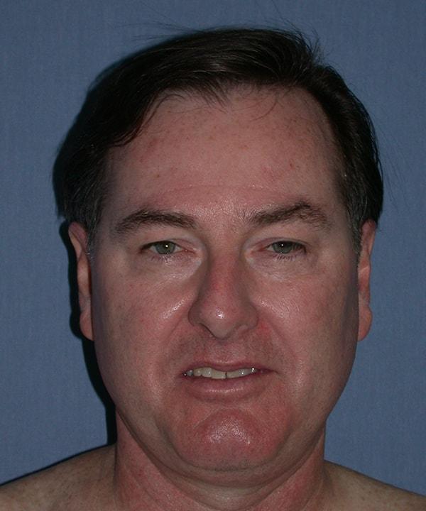 Blepharoplasty before at Herte Center for Cosmetic Surgery in Las Vegas, NV