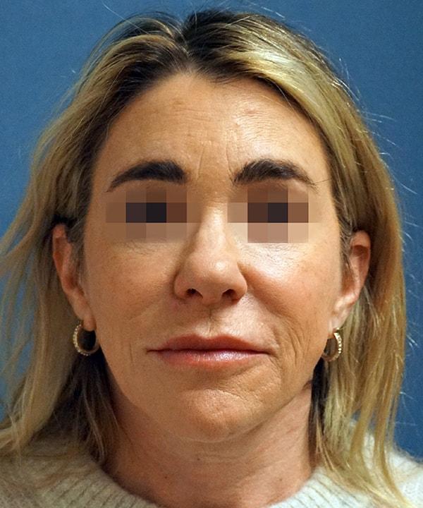 Brow Lift after at Herte Center for Cosmetic Surgery in Las Vegas, NV