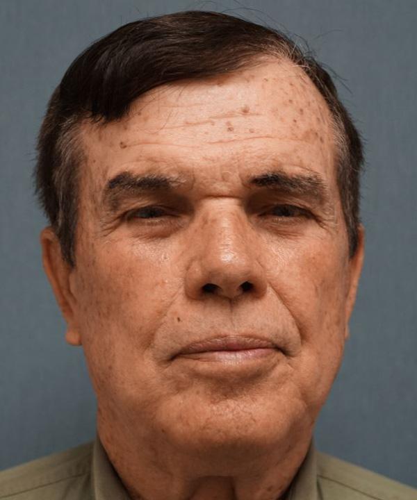 Blepharoplasty after at Herte Center for Cosmetic Surgery in Las Vegas, NV