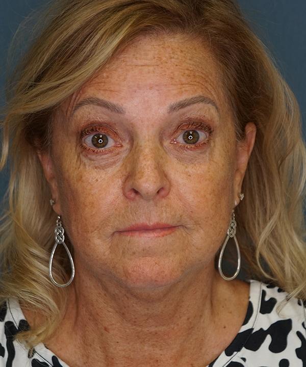 Brow Lift before at Herte Center for Cosmetic Surgery in Las Vegas, NV