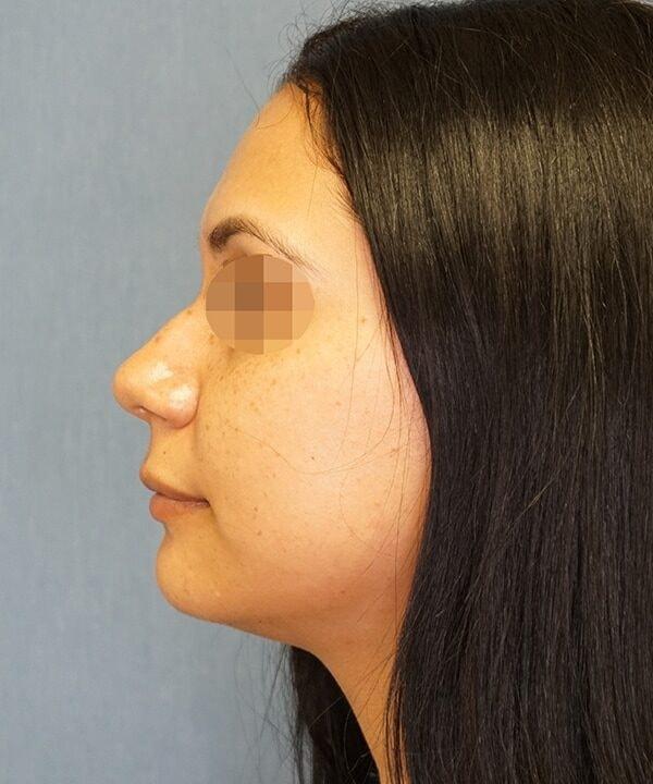 Herte Center for Cosmetic Surgery chin implant after — Las Vegas, NV