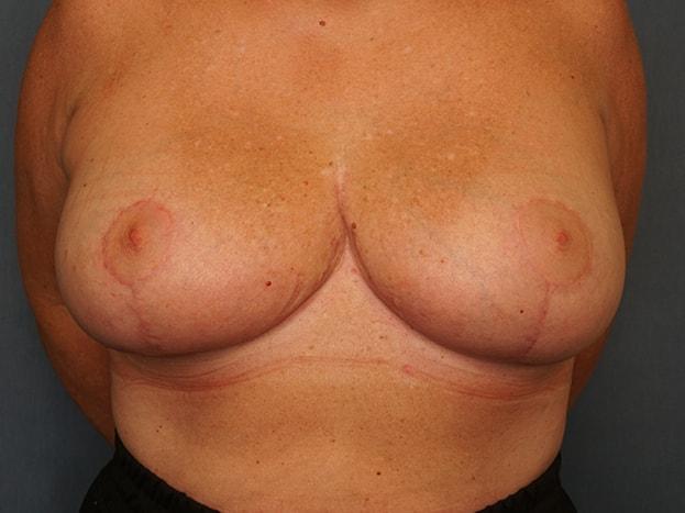 Breast Reduction after at Herte Center for Cosmetic Surgery in Las Vegas, NV