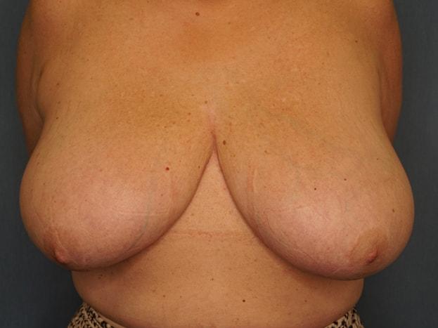Breast Reduction before at Herte Center for Cosmetic Surgery in Las Vegas, NV