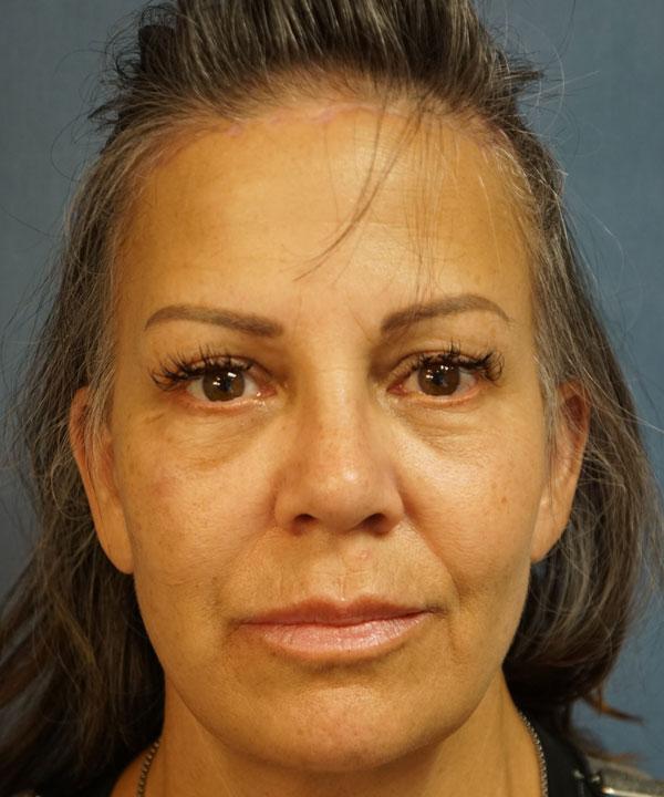 Brow Lift after at Herte Center for Cosmetic Surgery in Las Vegas, NV