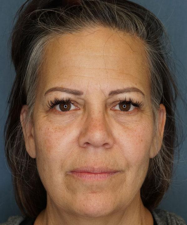 Brow Lift before at Herte Center for Cosmetic Surgery in Las Vegas, NV