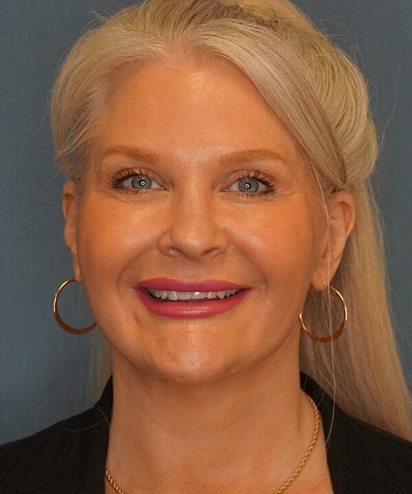 Herte Center for Cosmetic Surgery facelift after — Las Vegas, NV