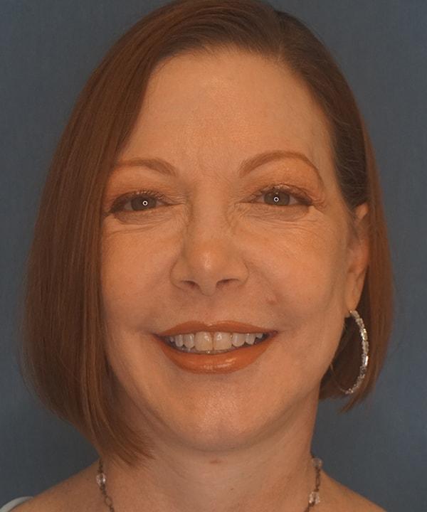 Herte Center for Cosmetic Surgery facelift after — Las Vegas, NV