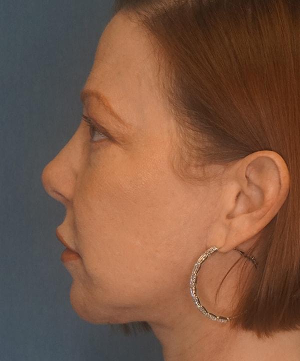 Herte Center for Cosmetic Surgery facelift after — Las Vegas, NV