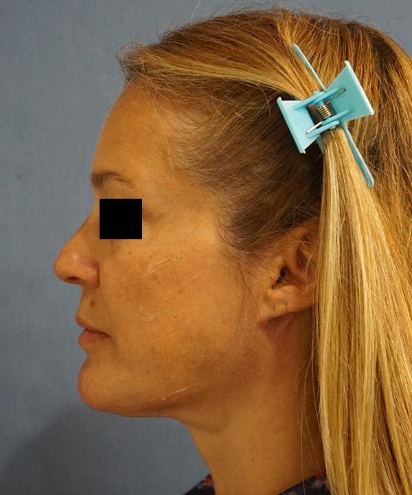 Herte Center for Cosmetic Surgery facelift after — Las Vegas, NV