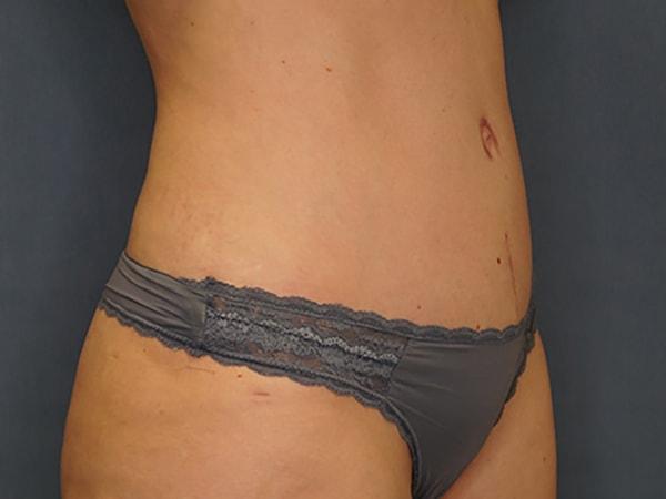 Mini Tummy Tuck after at Herte Center for Cosmetic Surgery in Las Vegas, NV