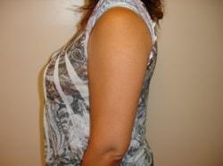 A. Bonelli, MD liposuction after — Safety Harbor, FL