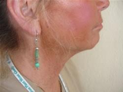 A. Bonelli, MD neck liposuction after — Safety Harbor, FL