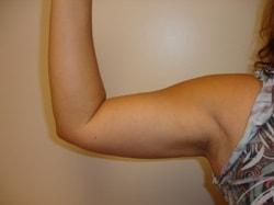 A. Bonelli, MD liposuction after — Safety Harbor, FL