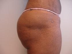 A. Bonelli, MD bbl after — Safety Harbor, FL