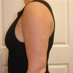 A. Bonelli, MD liposuction after — Safety Harbor, FL