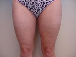 A. Bonelli, MD liposuction after — Safety Harbor, FL