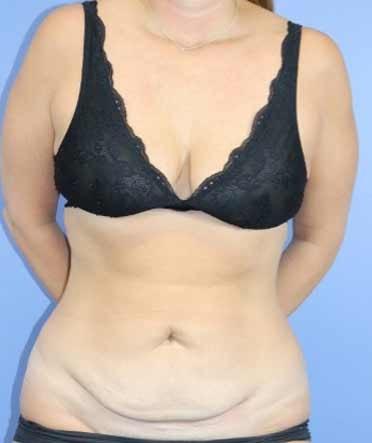 Tummy Tuck before at Michael Howard, MD in Lake Forest, IL
