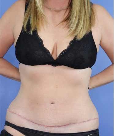 Tummy Tuck after at Michael Howard, MD in Lake Forest, IL