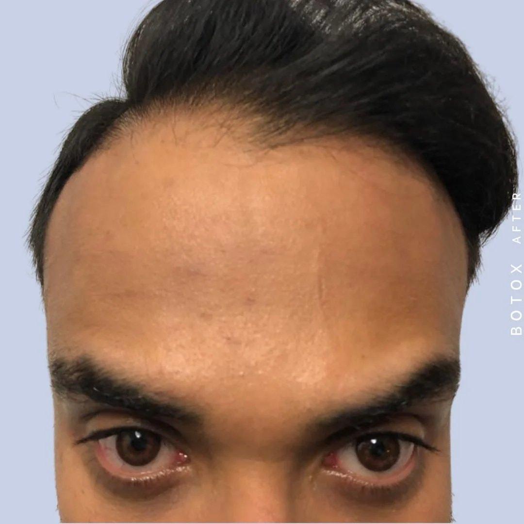 Hardik Doshi, MD, FACS botox after — New York, NY