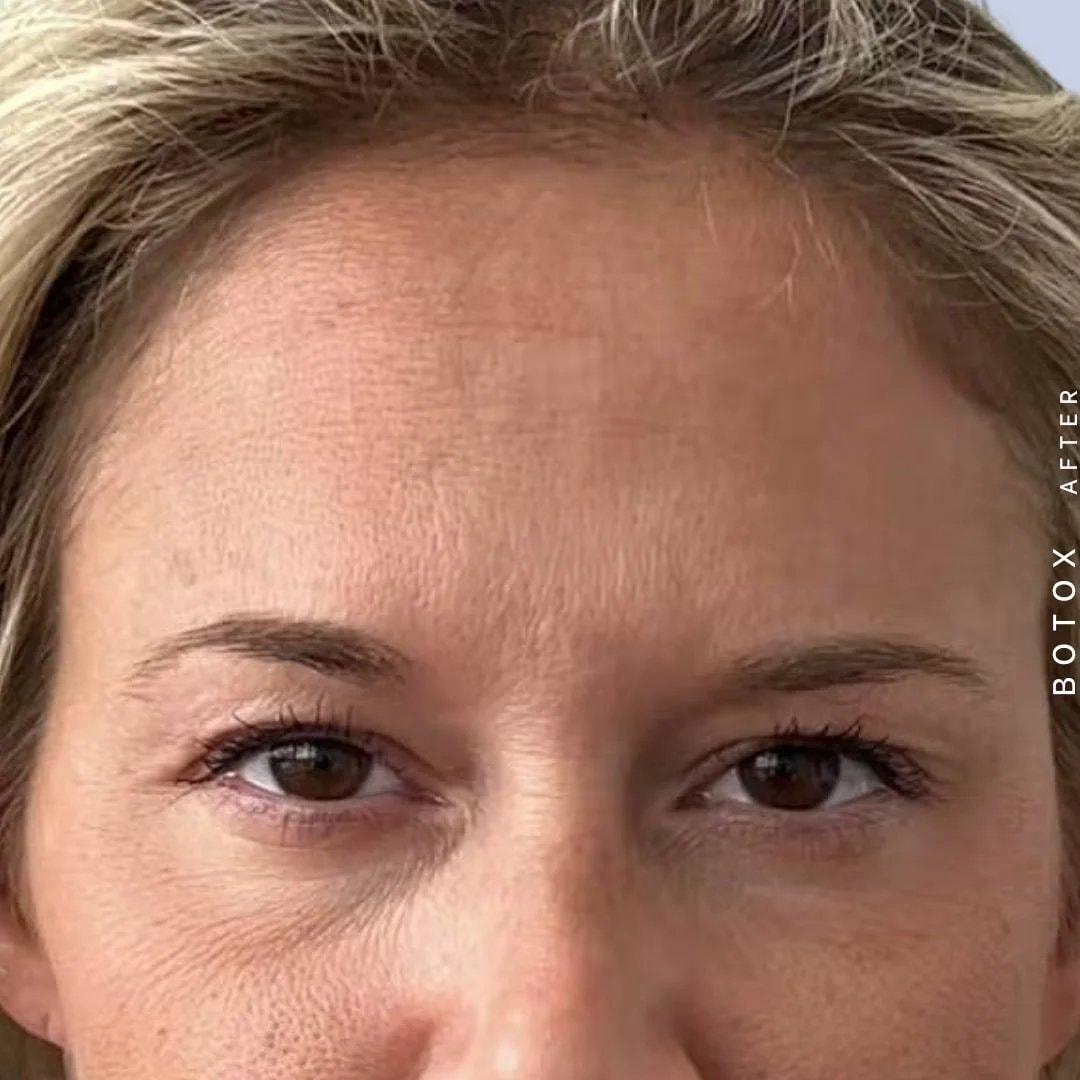 Hardik Doshi, MD, FACS botox after — New York, NY