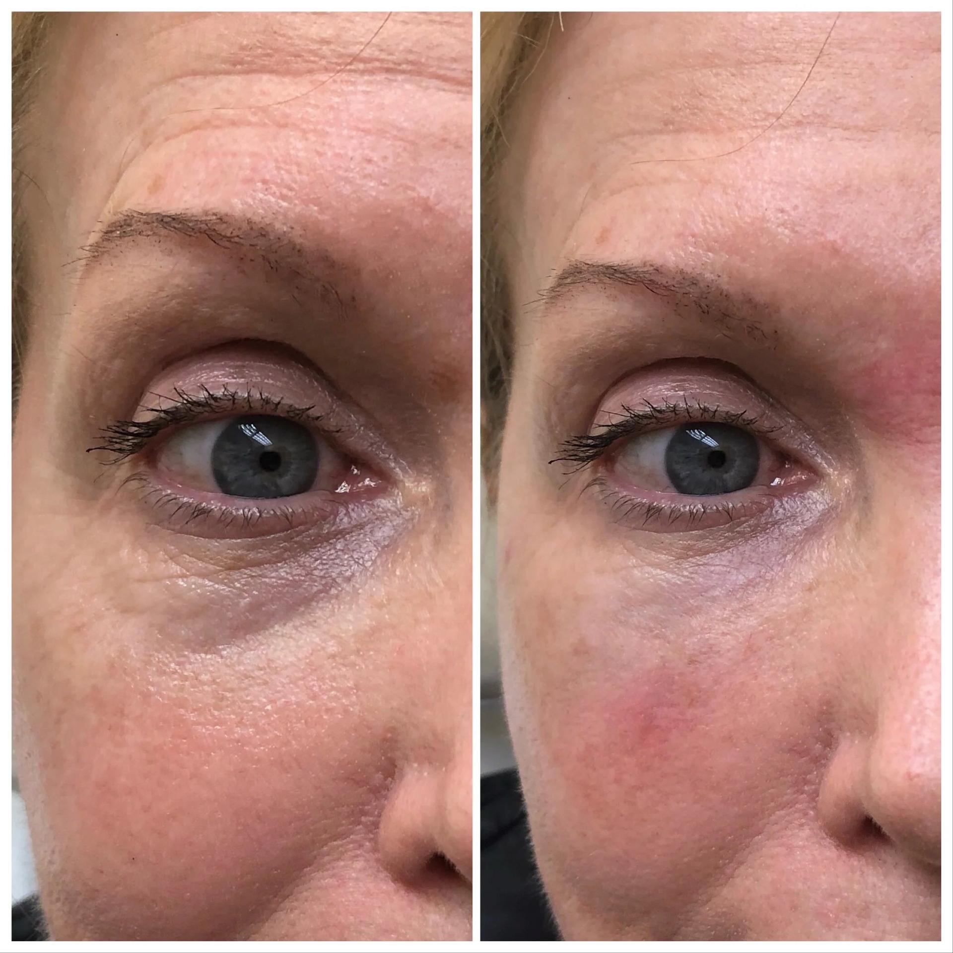 Hardik Doshi, MD, FACS under-eye filler result — New York, NY