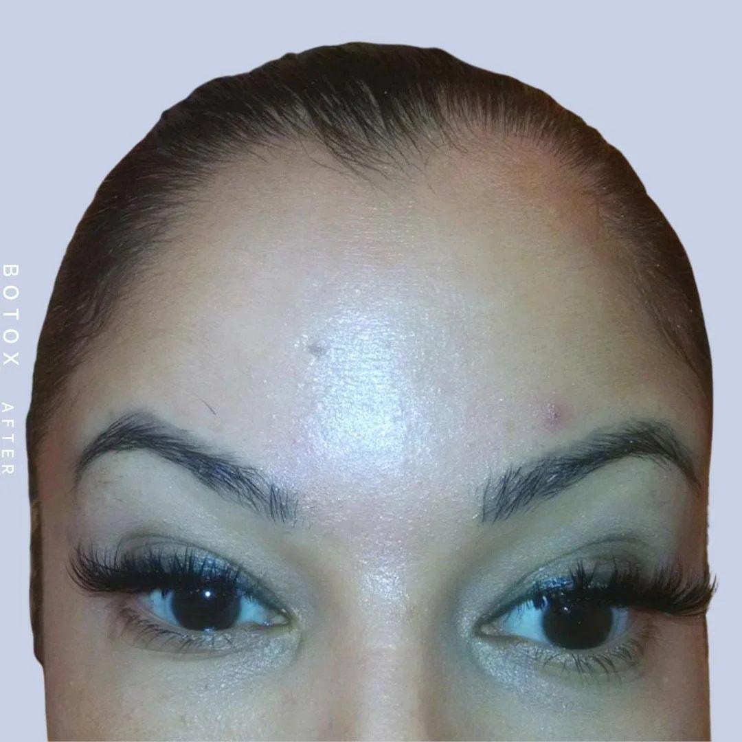 Hardik Doshi, MD, FACS botox after — New York, NY