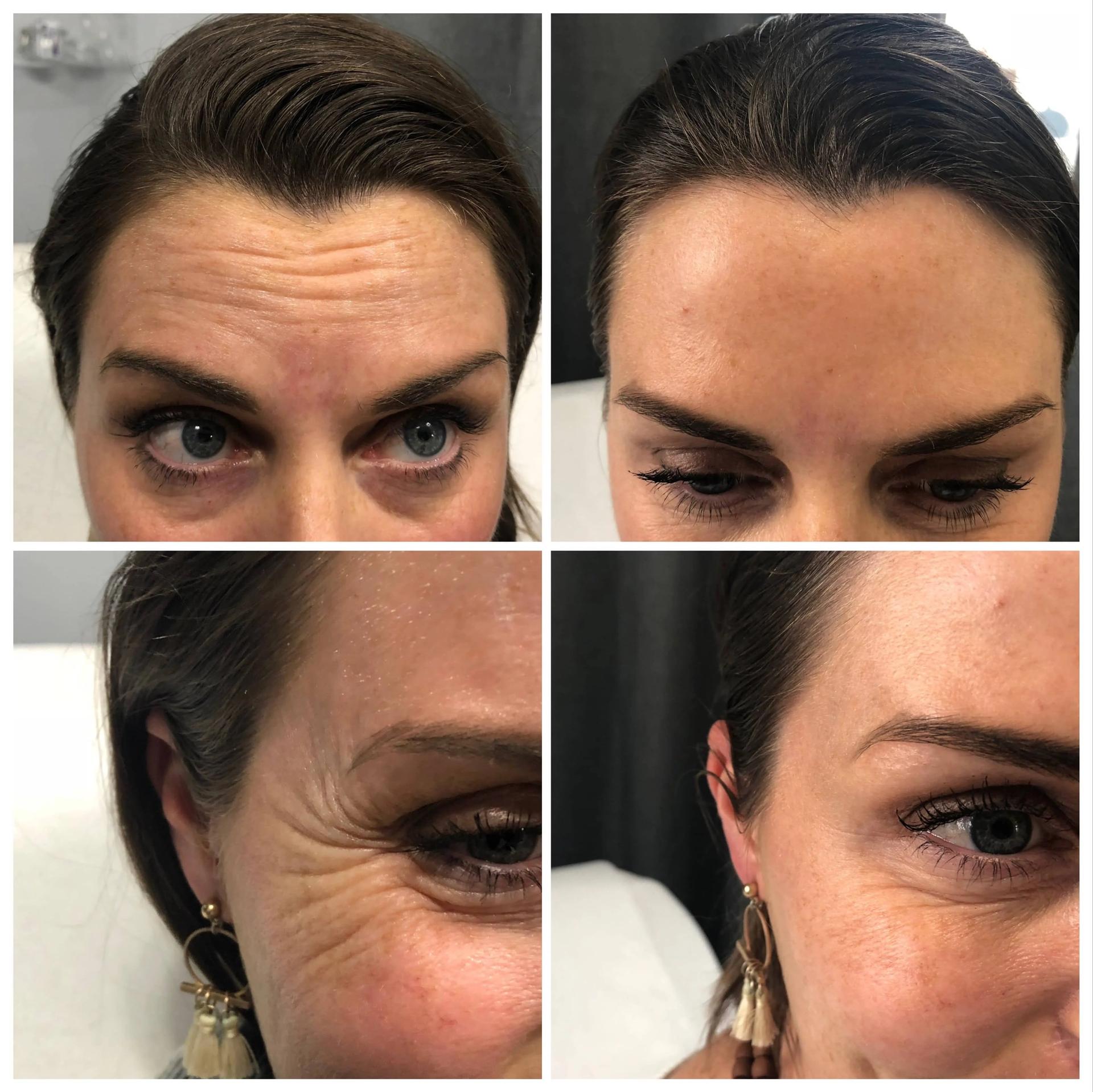 Hardik Doshi, MD, FACS botox result — New York, NY