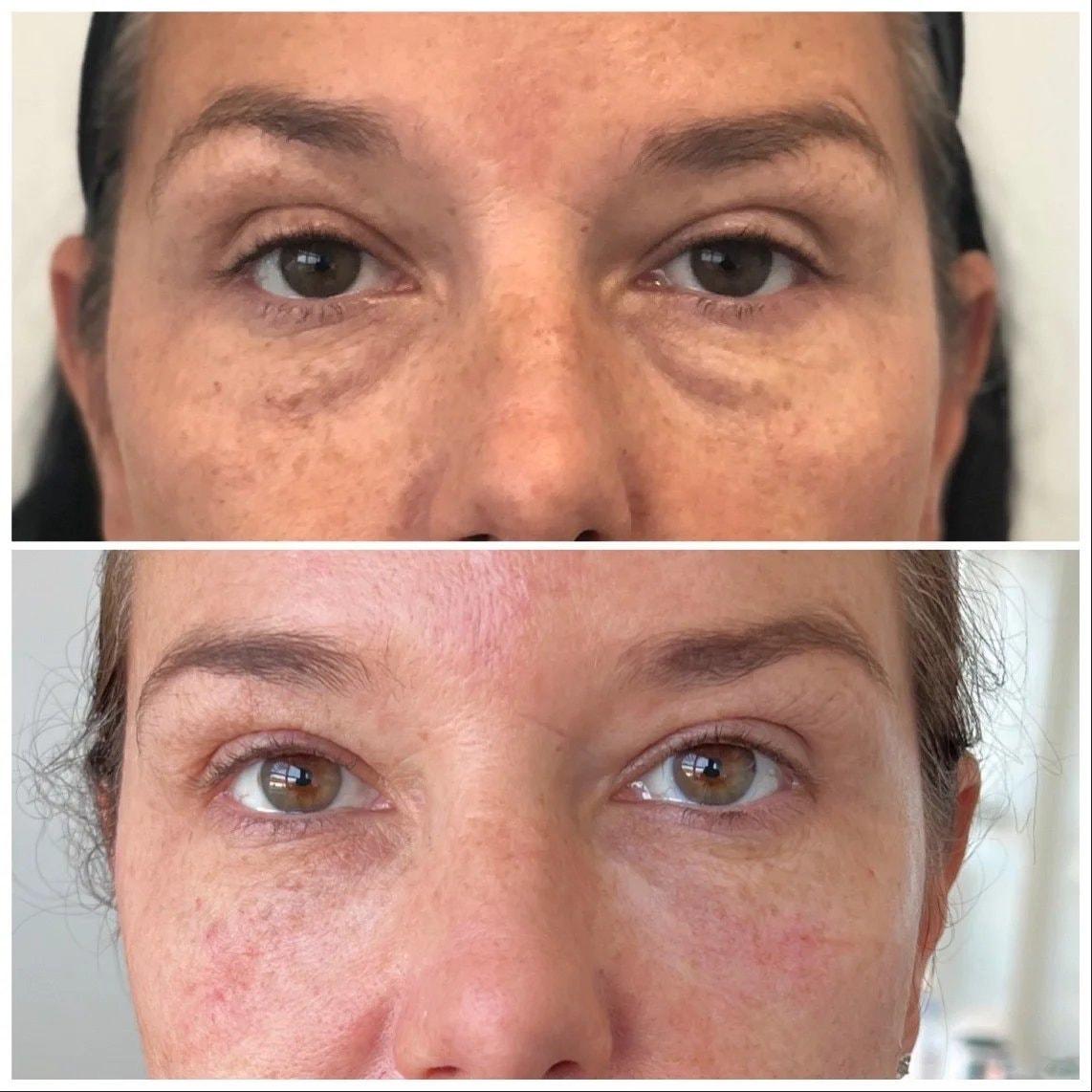 Hardik Doshi, MD, FACS under-eye filler result — New York, NY