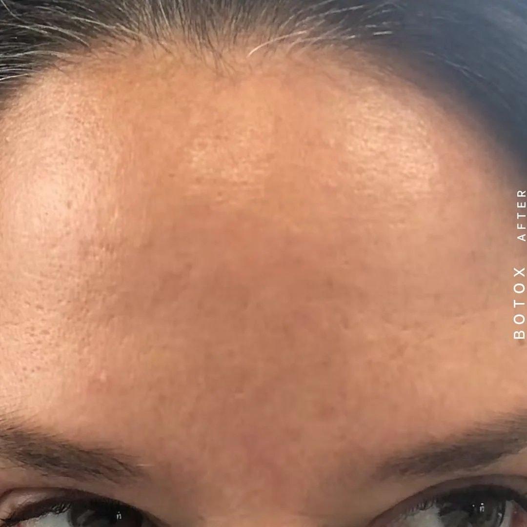 Hardik Doshi, MD, FACS botox after — New York, NY