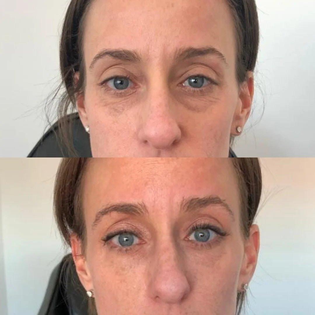 Hardik Doshi, MD, FACS under-eye filler result — New York, NY