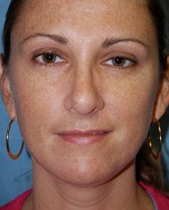 Christopher Saunders, MD rhinoplasty after — Chadds Ford, PA