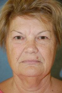 Blepharoplasty before at Christopher Saunders, MD in Chadds Ford, PA