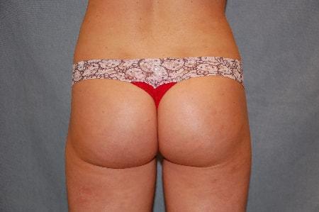 Brazilian Butt Lift after at Christopher Saunders, MD in Chadds Ford, PA