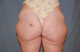 Thigh Lift before at Christopher Saunders, MD in Chadds Ford, PA