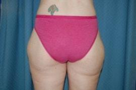 Thigh Lift after at Christopher Saunders, MD in Chadds Ford, PA