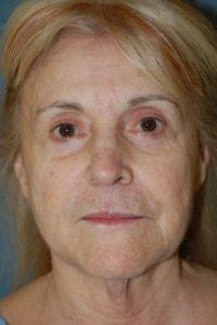 Deep Plane Facelift before at Christopher Saunders, MD in Chadds Ford, PA