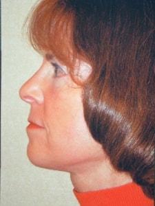 Christopher Saunders, MD facelift after — Chadds Ford, PA