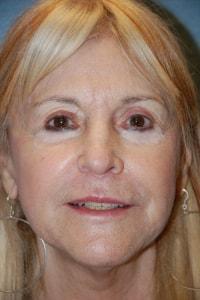 Christopher Saunders, MD facelift after — Chadds Ford, PA